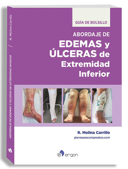 Abordaje de edemas y úlceras de extremidad inferior